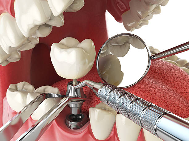 Best Emergency Root Canal Treatment in Arma, KS